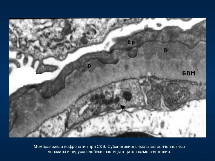 Мембранозная нефропатия при СКВ. Субэпителиальные электронноплотные депозиты и вирусоподобные частицы в цитоплазме эндотелия.