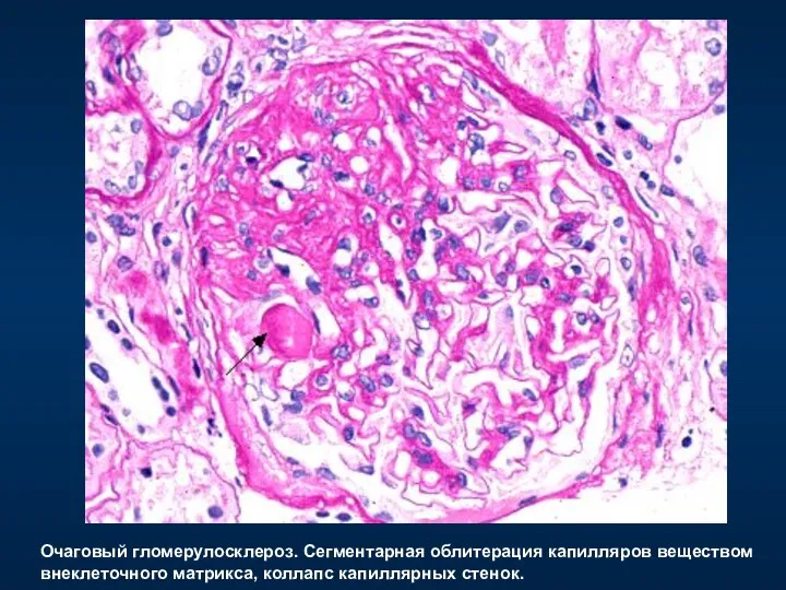 Очаговый гломерулосклероз. Сегментарная облитерация капилляров веществом внеклеточного матрикса, коллапс капиллярных стенок.