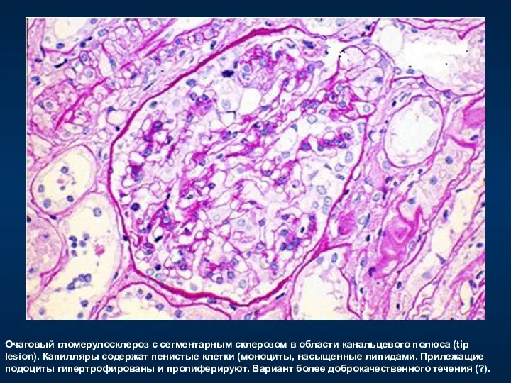 Очаговый гломерулосклероз c сегментарным склерозом в области канальцевого полюса (tip