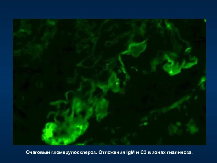 Очаговый гломерулосклероз. Отложения IgM и С3 в зонах гиалиноза.