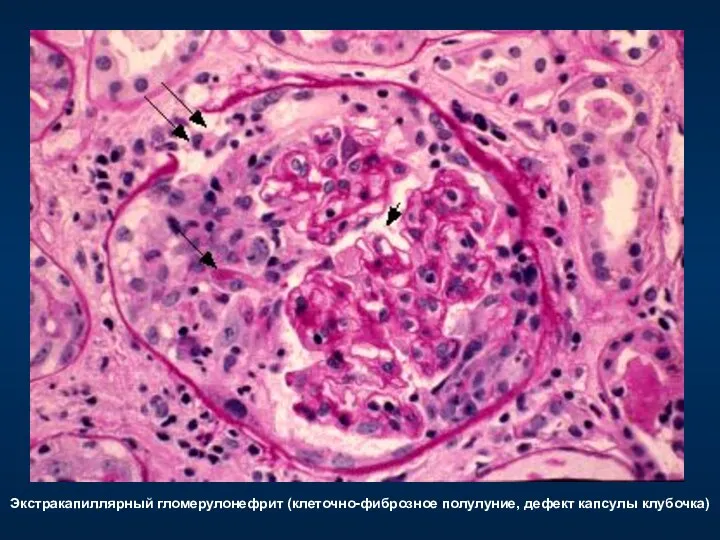 Экстракапиллярный гломерулонефрит (клеточно-фиброзное полулуние, дефект капсулы клубочка)