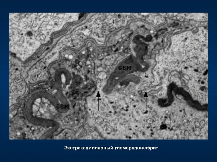 Экстракапиллярный гломерулонефрит