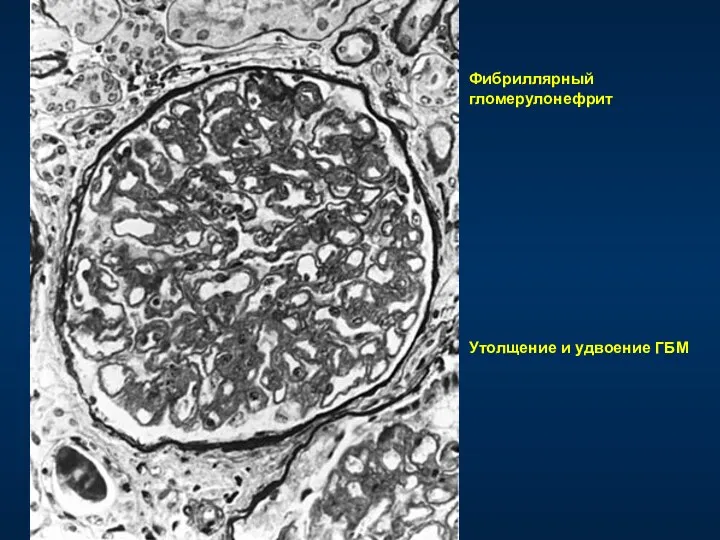 Фибриллярный гломерулонефрит Утолщение и удвоение ГБМ