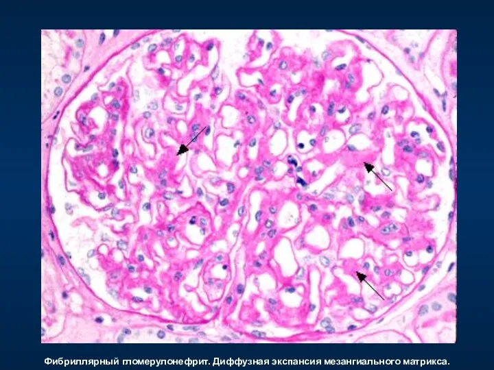 Фибриллярный гломерулонефрит. Диффузная экспансия мезангиального матрикса.