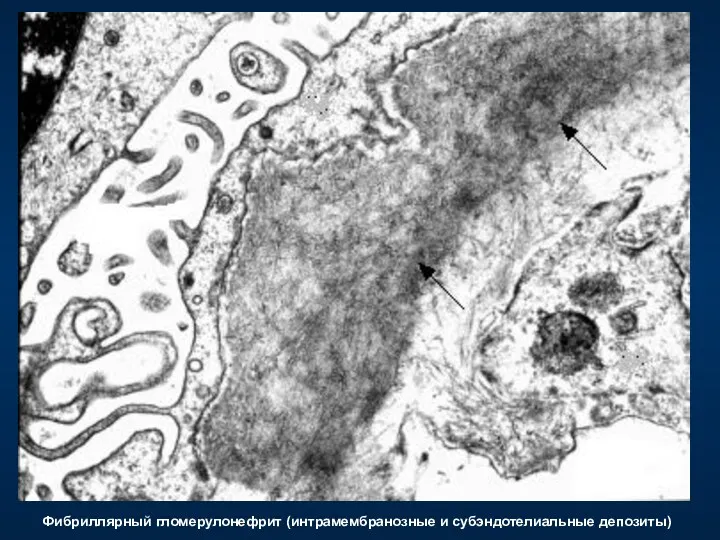 Фибриллярный гломерулонефрит (интрамембранозные и субэндотелиальные депозиты)