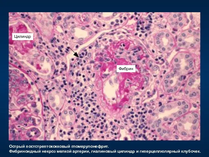 Фибрин Цилиндр Острый постстрептококковый гломерулонефрит. Фибриноидный некроз мелкой артерии, гиалиновый цилиндр и гиперцеллюлярный клубочек.