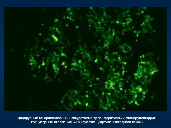 Диффузный генерализованный эксудативно-пролиферативный гломерулонефрит, гранулярные отложения С3 в клубочке (картина «звездного неба»)