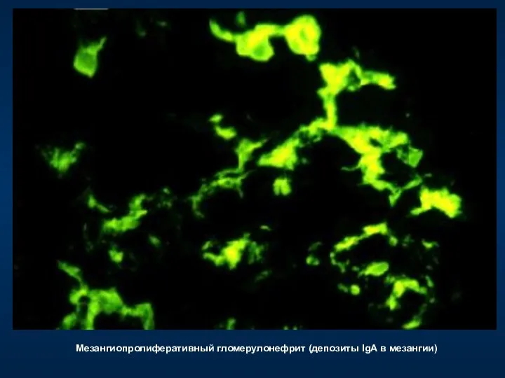 Мезангиопролиферативный гломерулонефрит (депозиты IgА в мезангии)