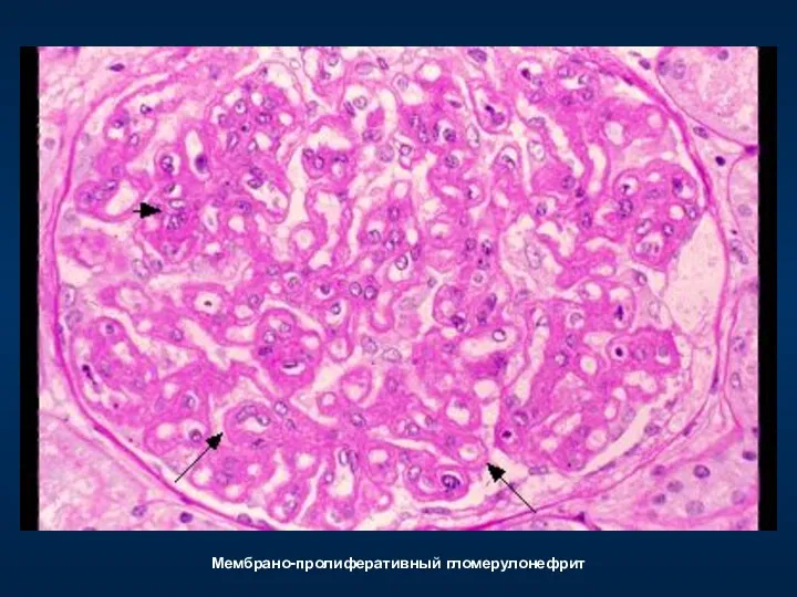 Мембрано-пролиферативный гломерулонефрит