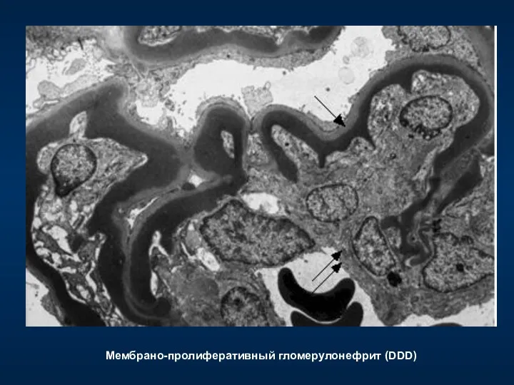 Мембрано-пролиферативный гломерулонефрит (DDD)