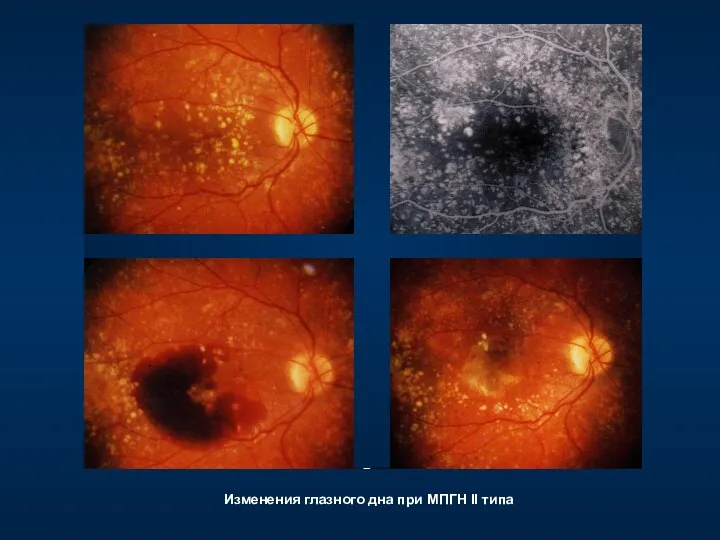 Изменения глазного дна при МПГН II типа