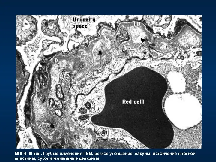МПГН, III тип. Грубые изменения ГБМ, резкое утолщение, лакуны, истончение плотной пластины, субэпителиальные депозиты