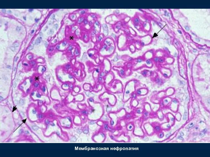 Мембранозная нефропатия
