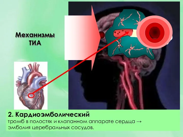 2. Кардиоэмболический тромб в полостях и клапанном аппарате сердца → эмболия церебральных сосудов. Механизмы ТИА