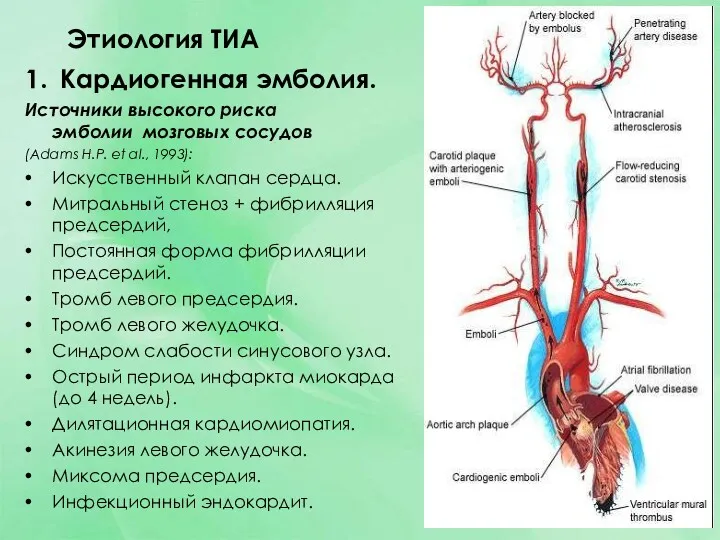 Этиология ТИА 1. Кардиогенная эмболия. Источники высокого риска эмболии мозговых сосудов (Adams H.P.