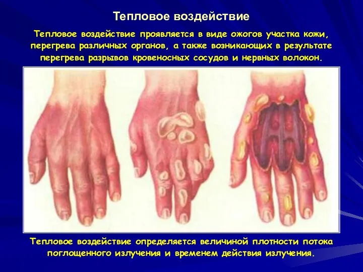 Тепловое воздействие Тепловое воздействие проявляется в виде ожогов участка кожи,