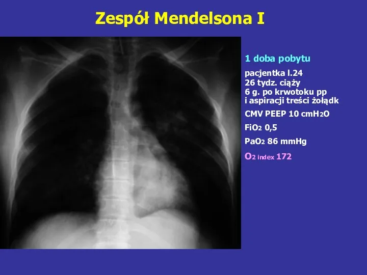 Zespół Mendelsona I 1 doba pobytu pacjentka l.24 26 tydz.