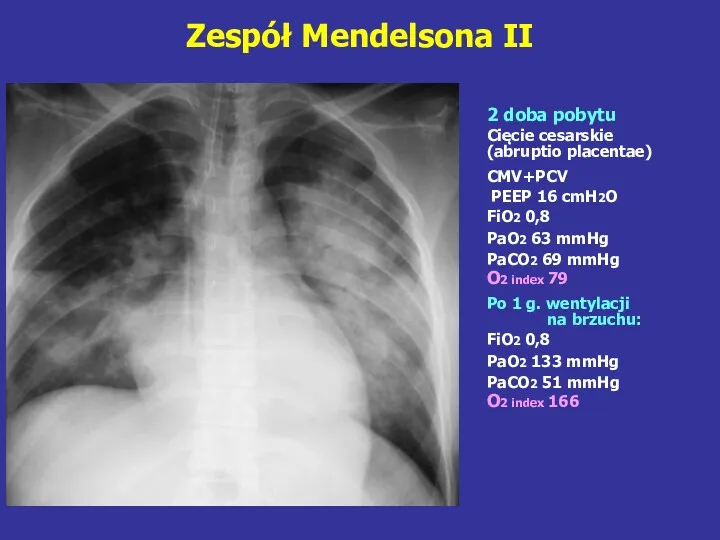 Zespół Mendelsona II 2 doba pobytu Cięcie cesarskie (abruptio placentae)