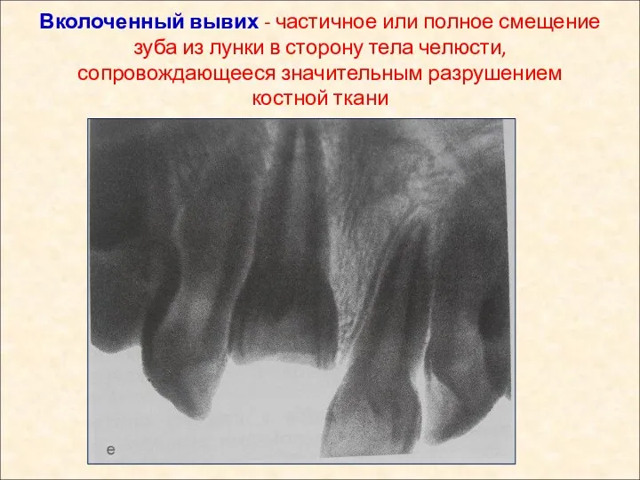 Вколоченный вывих - частичное или полное смещение зуба из лунки