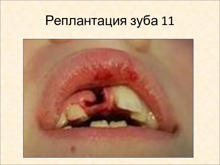 Реплантация зуба 11