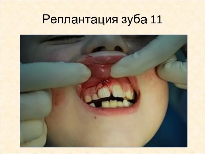 Реплантация зуба 11