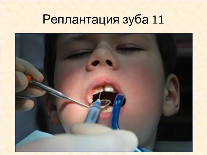 Реплантация зуба 11