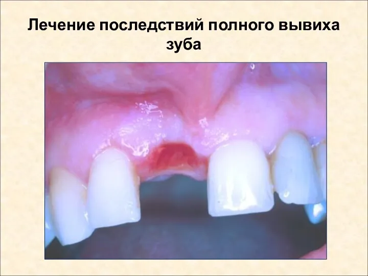 Лечение последствий полного вывиха зуба