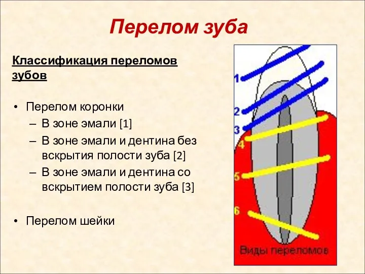 Перелом зуба Классификация переломов зубов Перелом коронки В зоне эмали