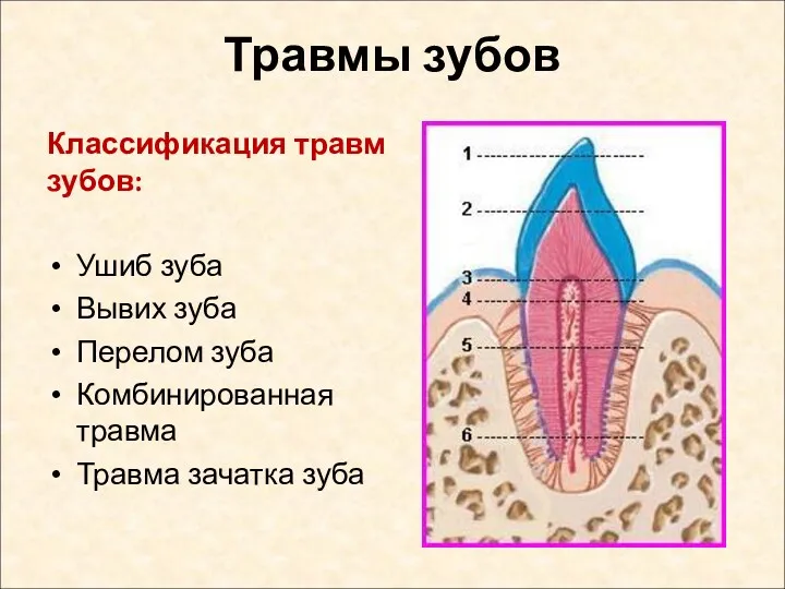 Травмы зубов Классификация травм зубов: Ушиб зуба Вывих зуба Перелом зуба Комбинированная травма Травма зачатка зуба