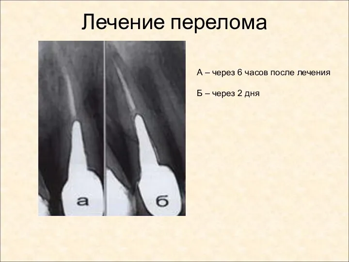 Лечение перелома А – через 6 часов после лечения Б – через 2 дня