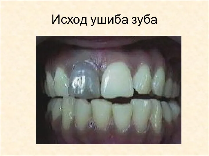 Исход ушиба зуба