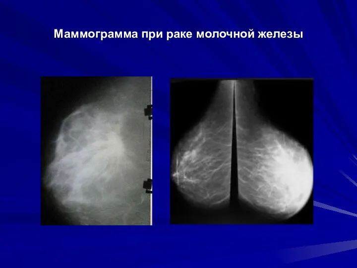 Маммограмма при раке молочной железы