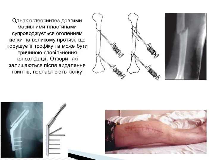Однак остеосинтез довгими масивними пластинами супроводжується оголенням кістки на великому протязі, що порушує