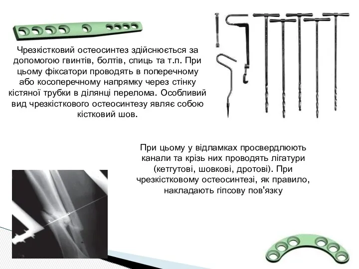 Чрезкістковий остеосинтез здійснюється за допомогою гвинтів, болтів, спиць та т.п.