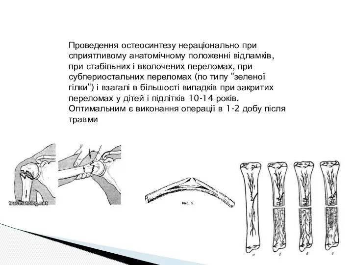 Проведення остеосинтезу нераціонально при сприятливому анатомічному положенні відламків, при стабільних