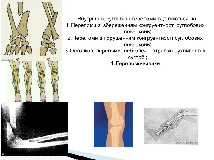 Внутрішньосуглобові переломи поділяються на: Переломи зі збереженням конгруентності суглобових поверхонь; Переломи з порушенням