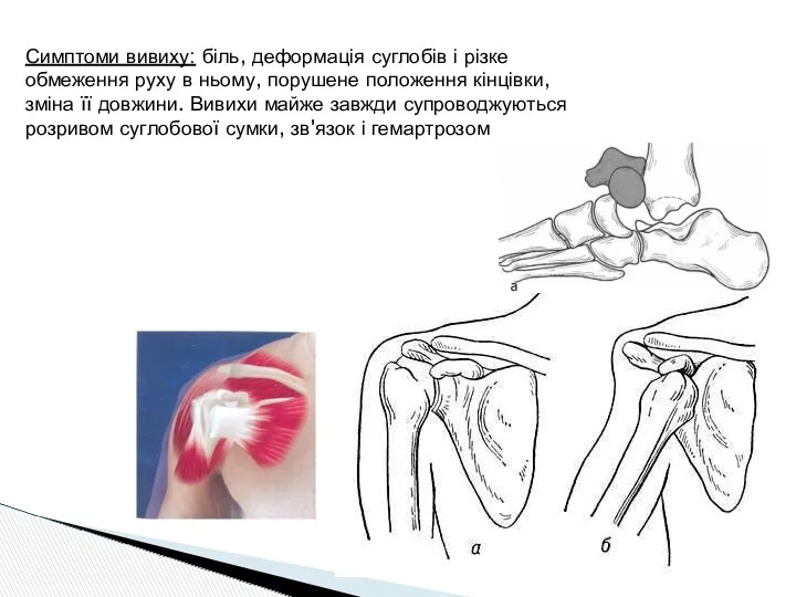 Симптоми вивиху: біль, деформація суглобів і різке обмеження руху в ньому, порушене положення