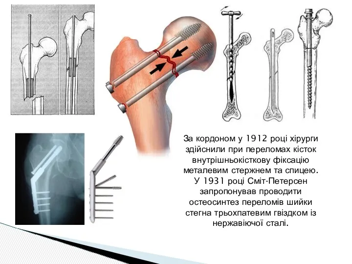 За кордоном у 1912 році хірурги здійснили при переломах кісток внутрішньокісткову фіксацію металевим