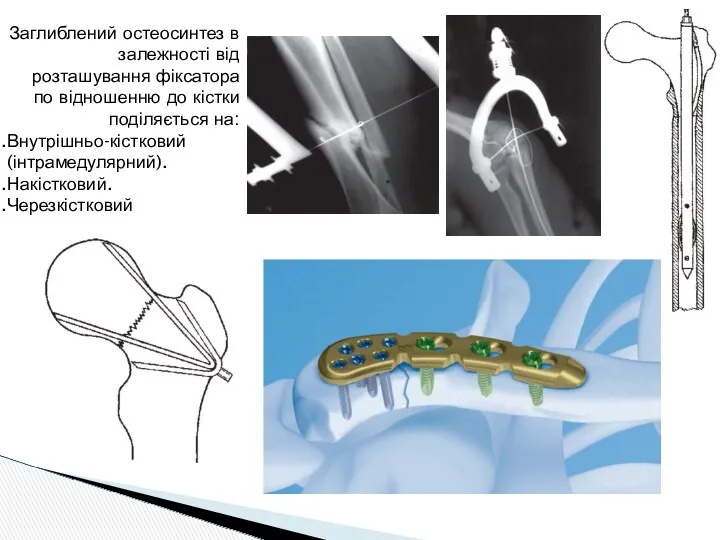 Заглиблений остеосинтез в залежності від розташування фіксатора по відношенню до