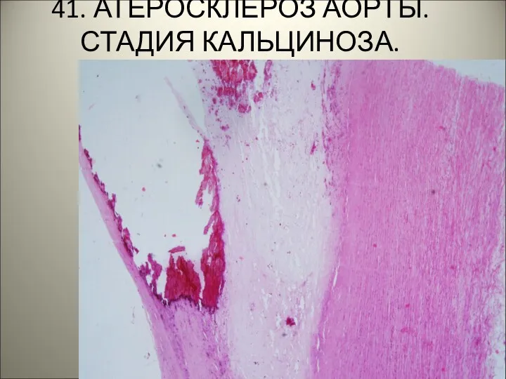 41. АТЕРОСКЛЕРОЗ АОРТЫ. СТАДИЯ КАЛЬЦИНОЗА. .