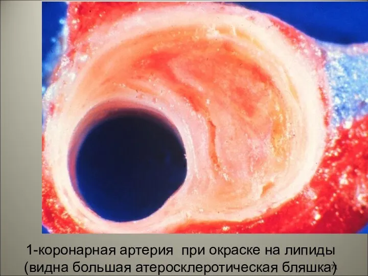 1-коронарная артерия при окраске на липиды (видна большая атеросклеротическая бляшка)