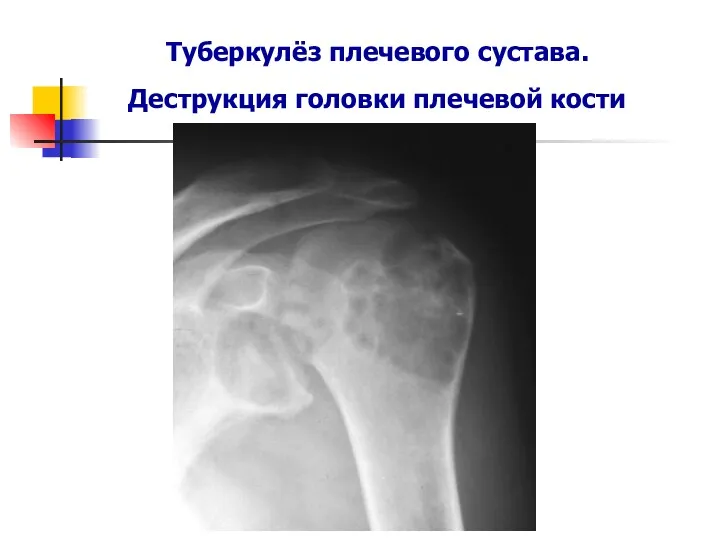 Туберкулёз плечевого сустава. Деструкция головки плечевой кости