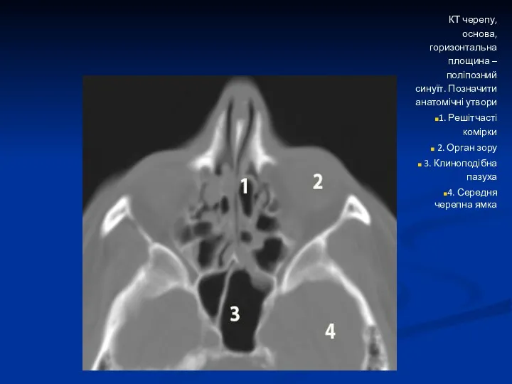 КТ черепу, основа, горизонтальна площина –поліпозний синуїт. Позначити анатомічні утвори