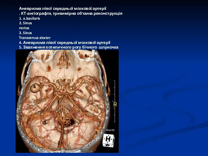 Аневризма лівої середньої мозкової артерії . КТ-ангіографія, тривимірна об’ємна реконструкція