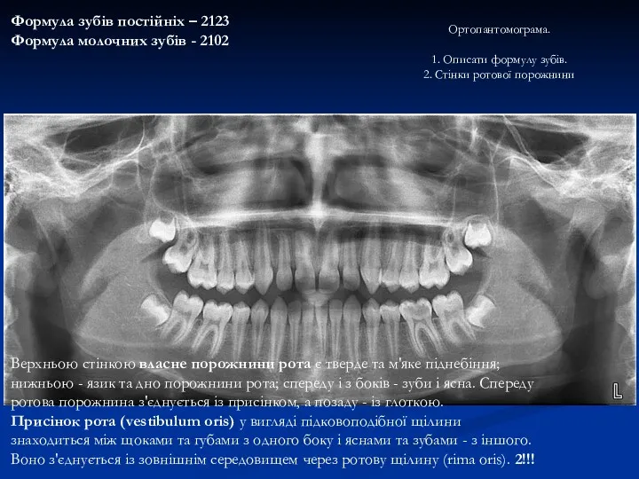 Ортопантомограма. 1. Описати формулу зубів. 2. Стінки ротової порожнини Формула