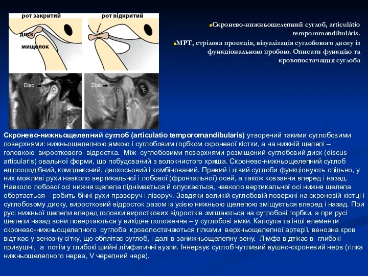 Скронево-нижньощелепний суглоб, articulátio temporomandibuláris. МРТ, стрілова проекція, візуалізація суглобового диску