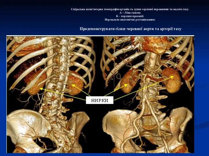 Спіральна комп’ютерна томографія органів та судин черевної порожнини та малого