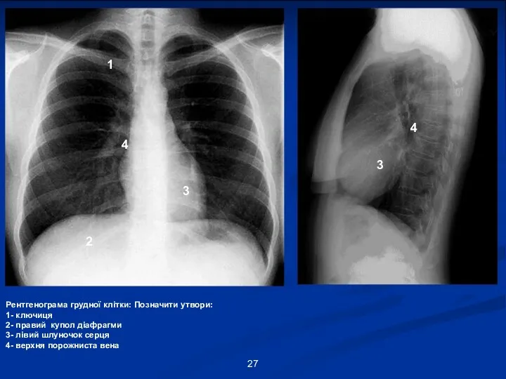 1 2 3 4 Рентгенограма грудної клітки: Позначити утвори: 1-