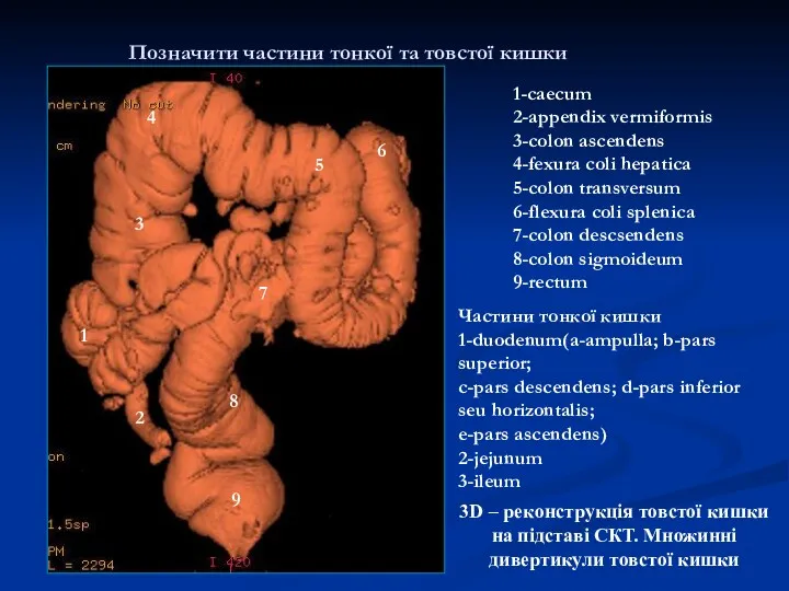 Позначити частини тонкої та товстої кишки 3D – реконструкція товстої