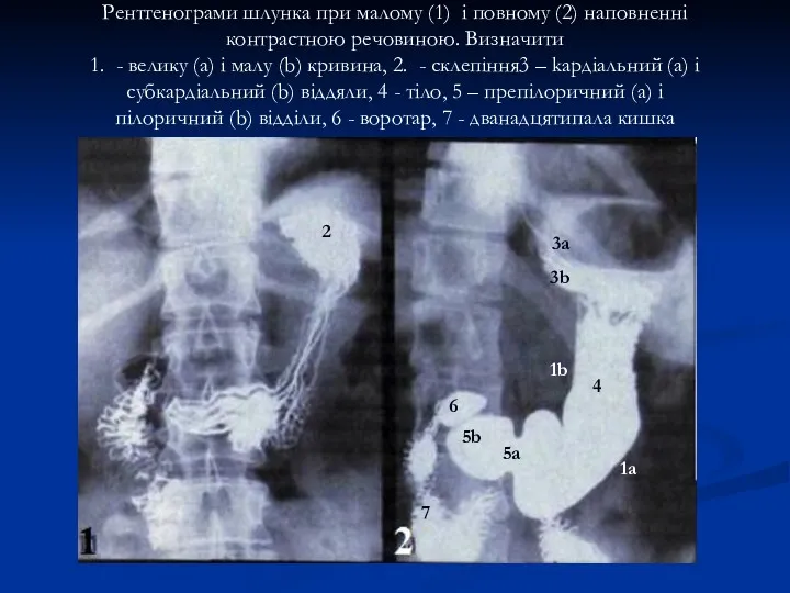 Рентгенограми шлунка при малому (1) і повному (2) наповненні контрастною